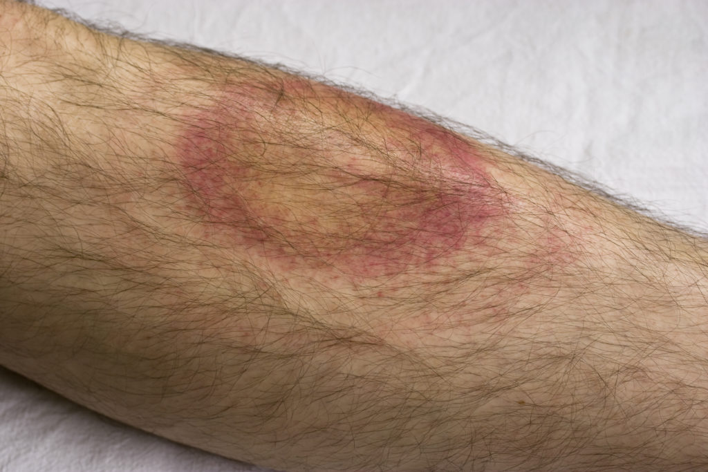 Lyme Rash GettyImages 173937233 What Are Ticks?